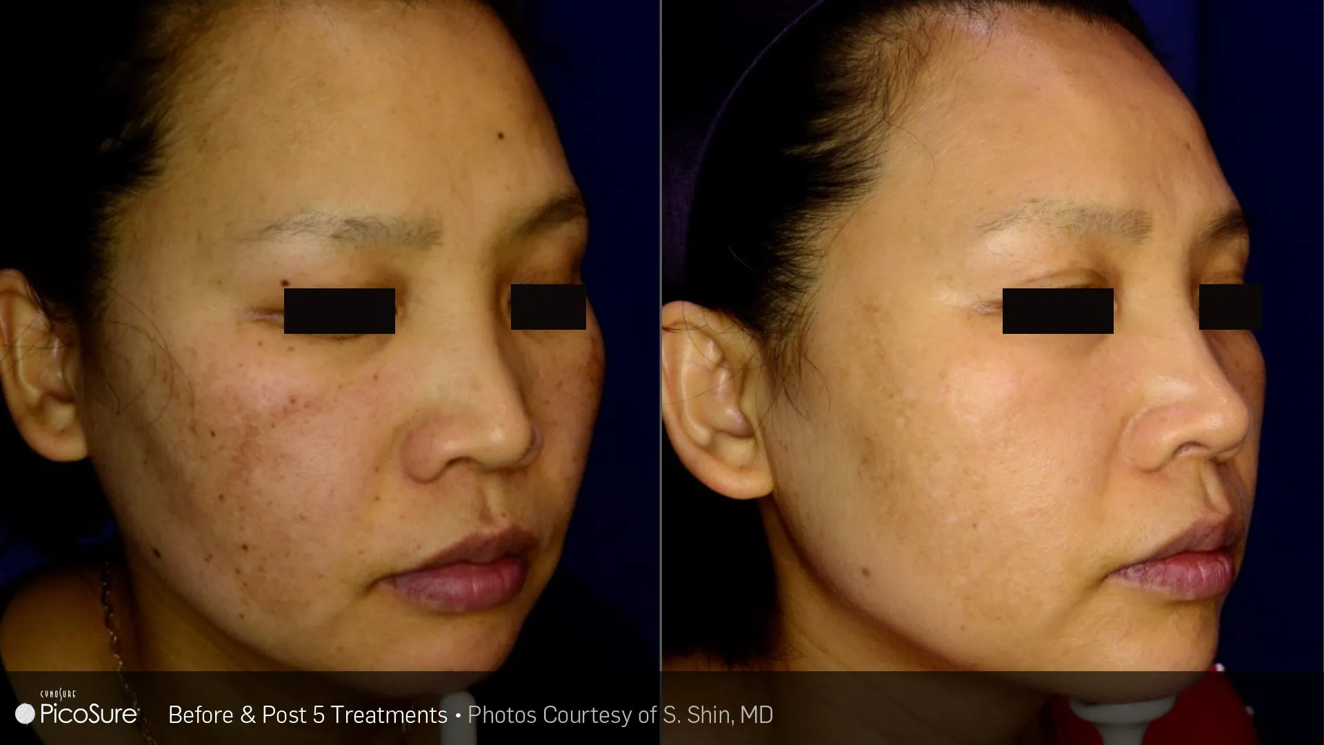 Skin rejuvenation results